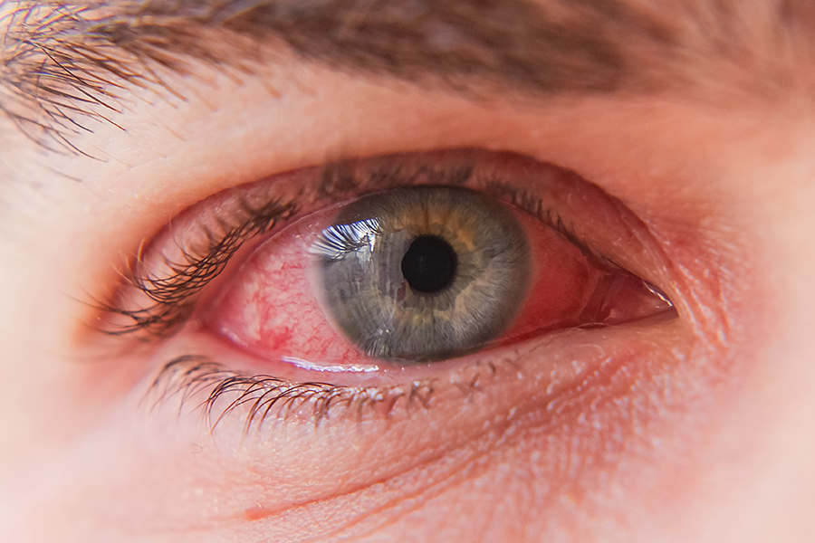 Macro closeup of conjunctivitis infected red eye